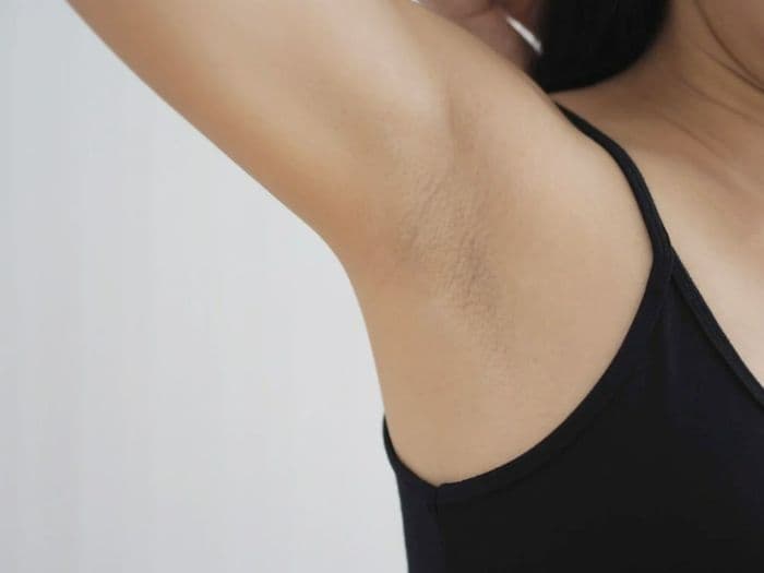 cara_mencerahkan_ketiak_dengan_ipl_dan_chemical_peeling_simak_tips_dari_dokter
