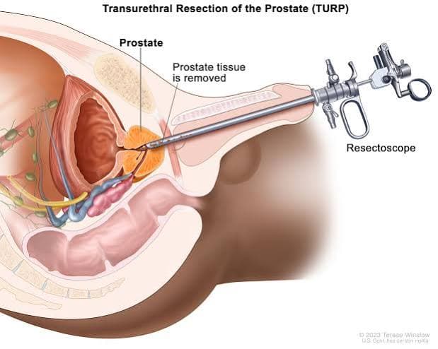 operasi_kanker_prostat_bikin_impotensi_dokter_ungkap_risiko_dan_teknik_nerve_sparing